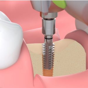 Implantmed Plus - Imagen 3